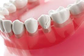 How Timely Tooth Replacement Prevents Further Oral Complications