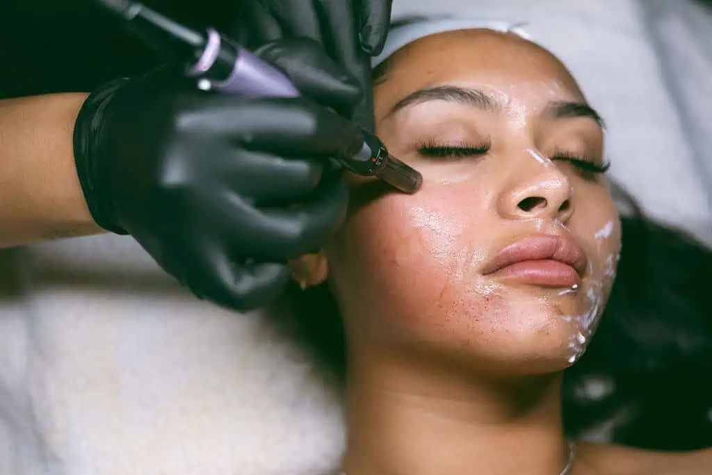 Microneedling Benefits and Techniques